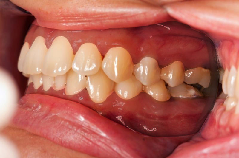 What makes your gums darker?