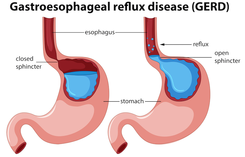 GERD acid reflux disease illustration