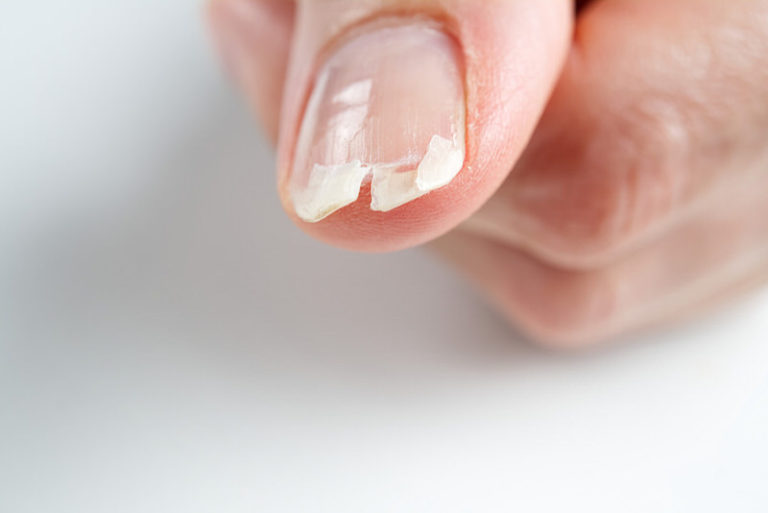 What Do You Do If Your Nail Gets Ripped Off