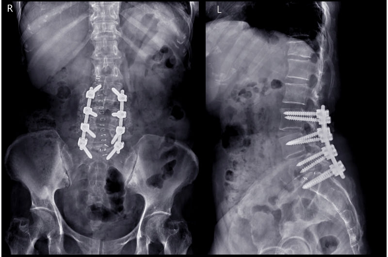 An x-ray showing someone with spinal hardware screws used during lower back surgery to reduce pain for the patient.