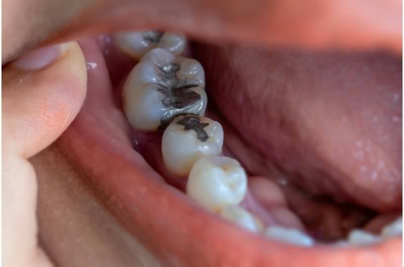 A person is opening his mouth to show some older dental fillings in his molars.