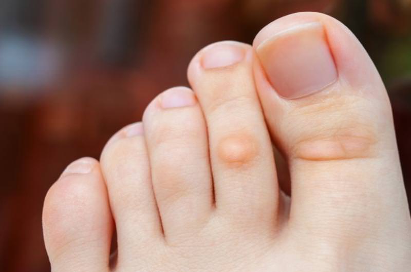 how-to-get-rid-of-calluses-on-the-feet-healthy-skin-care-callus