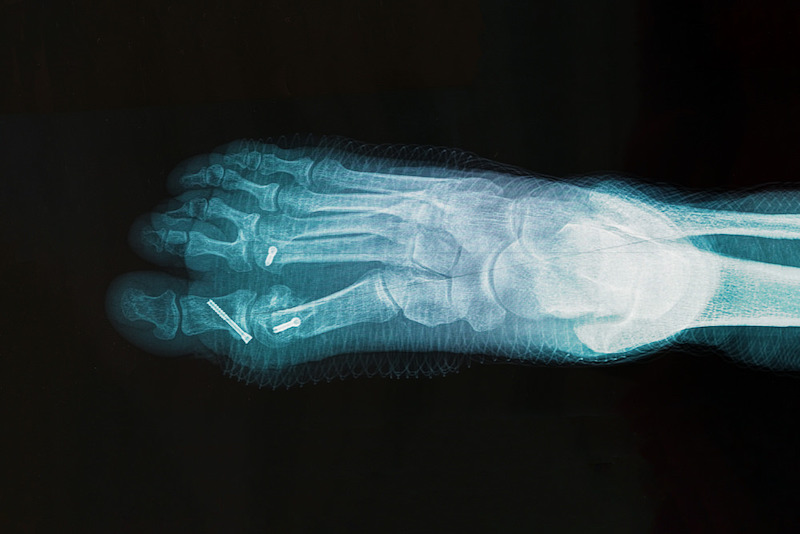 An x-ray shows a post bunion surgery complication, where the screw used to keep the bone together has broken.