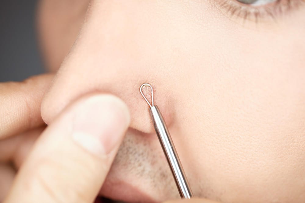 A young man is using a comedone extractor to remove blackheads on his nose