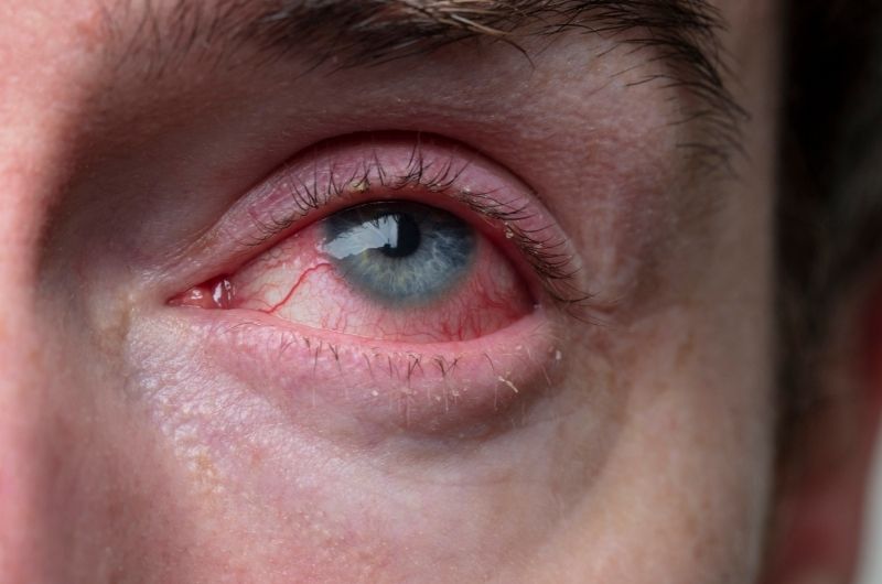 A man with blepharitis is feeling symptoms like red and watery eyes