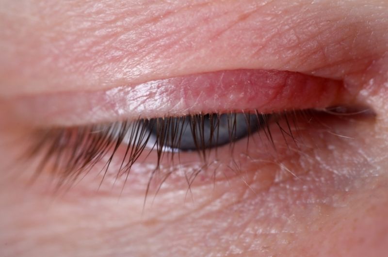 A man with blepharitis has an irritated right eyelid