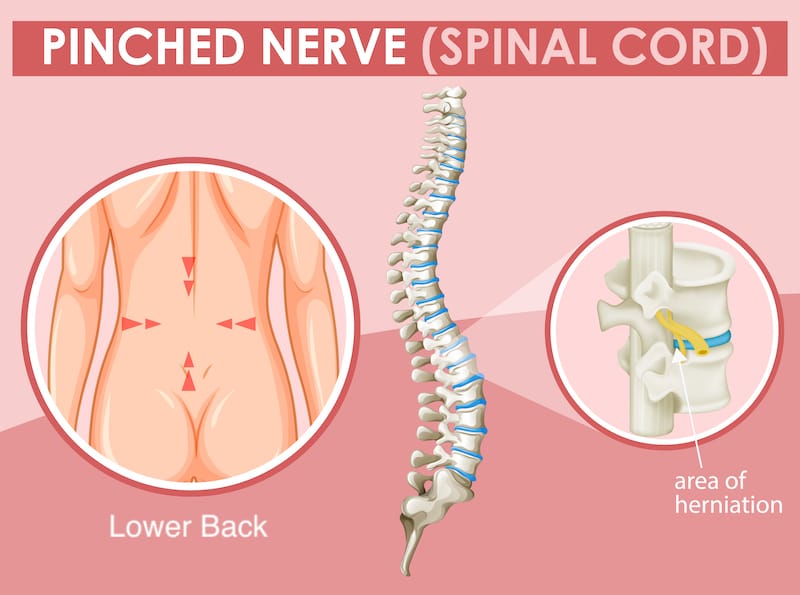 A diagram showing a lower back pinched nerve and the area of herniation