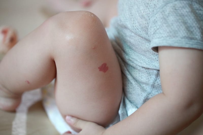 A baby with a strawberry hemangioma on his left thigh