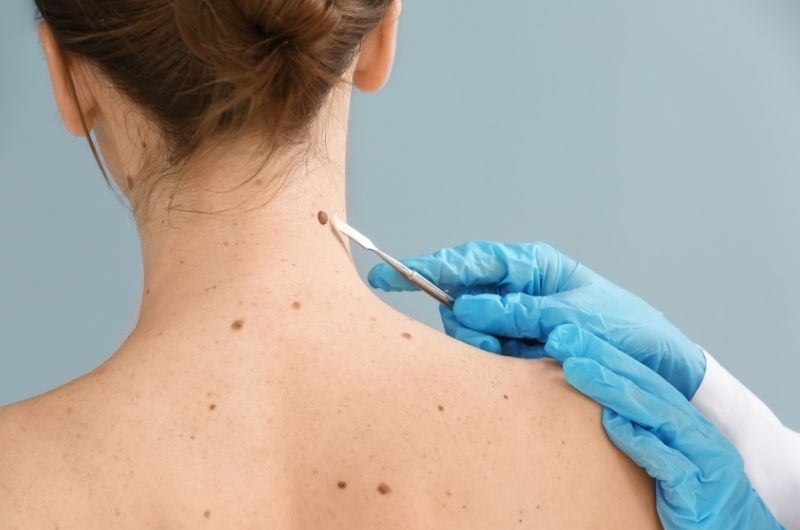 A doctor is removing a mole from his female patient's neck with a lancet