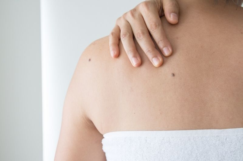 A woman is showing a mole that's on her upper back
