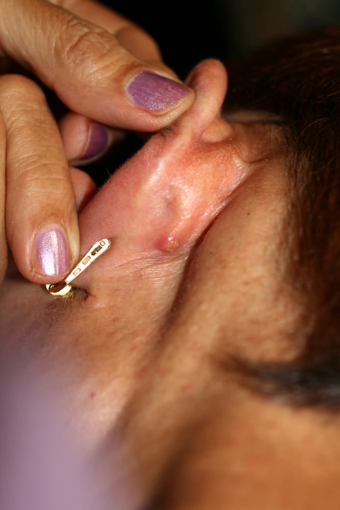 A close-up picture of someone with a skin abscess behind their ear