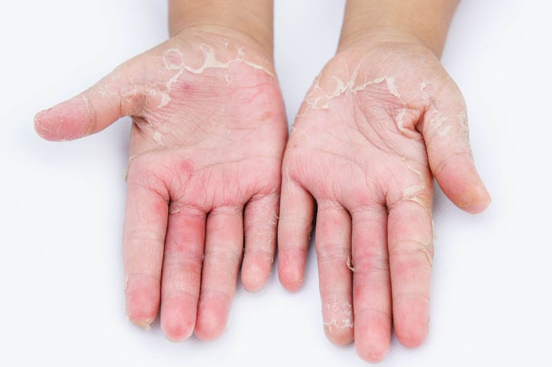 A person with contact dermatitis is showing the palm of both their hands, which look very scaly, red, and dry.