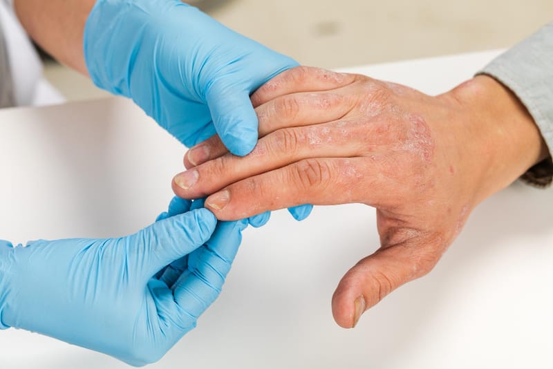 A dermatologist is examining his patient's hand, which has eczema on it.