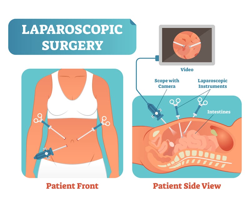 A graphic showing a patient's front view and side view during Laparoscopic surgery.