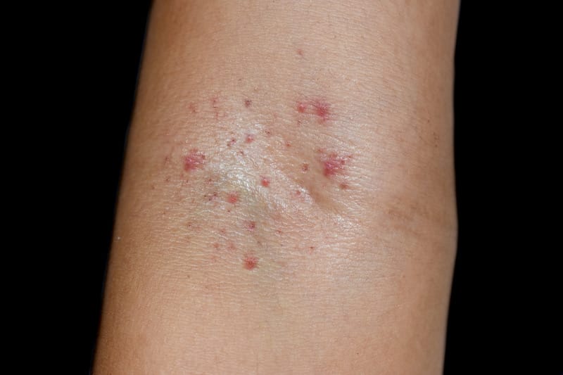 Red spots, known as Petechiae, are shown on a person's skin by their elbow