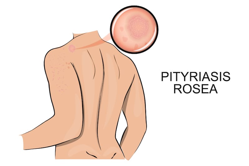 A graphic showing a person's upper back where a pityriasis rosea rash is located.