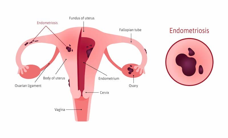 A diagram of the female reproductive system, highlighting endometriosis and how it affects the ovaries.