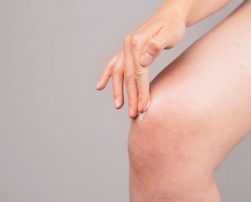 Woman rubbing ointment to reduce swelling due to Amlodipine