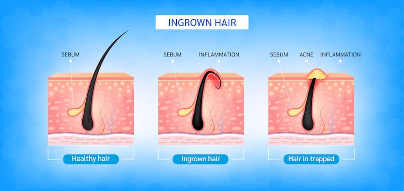 A graphic showing the differences and reactions between healthy hair growth, ingrown hair growth, and hair that's trapped inside the skin.