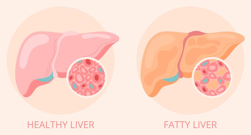 A drawing of a healthy liver compared to a fatty liver