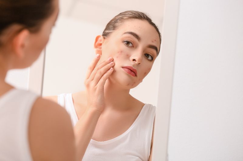 A young woman is looking at the acne on her face through a mirror