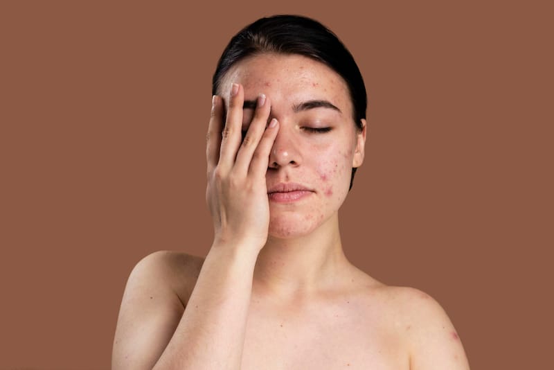 A young woman has her eyes closed and is touching the acne and acne scars on her face