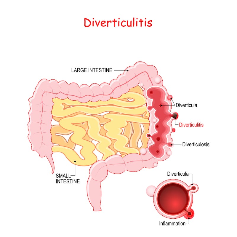 A graphic showing how diverticulitis affects the large intestine