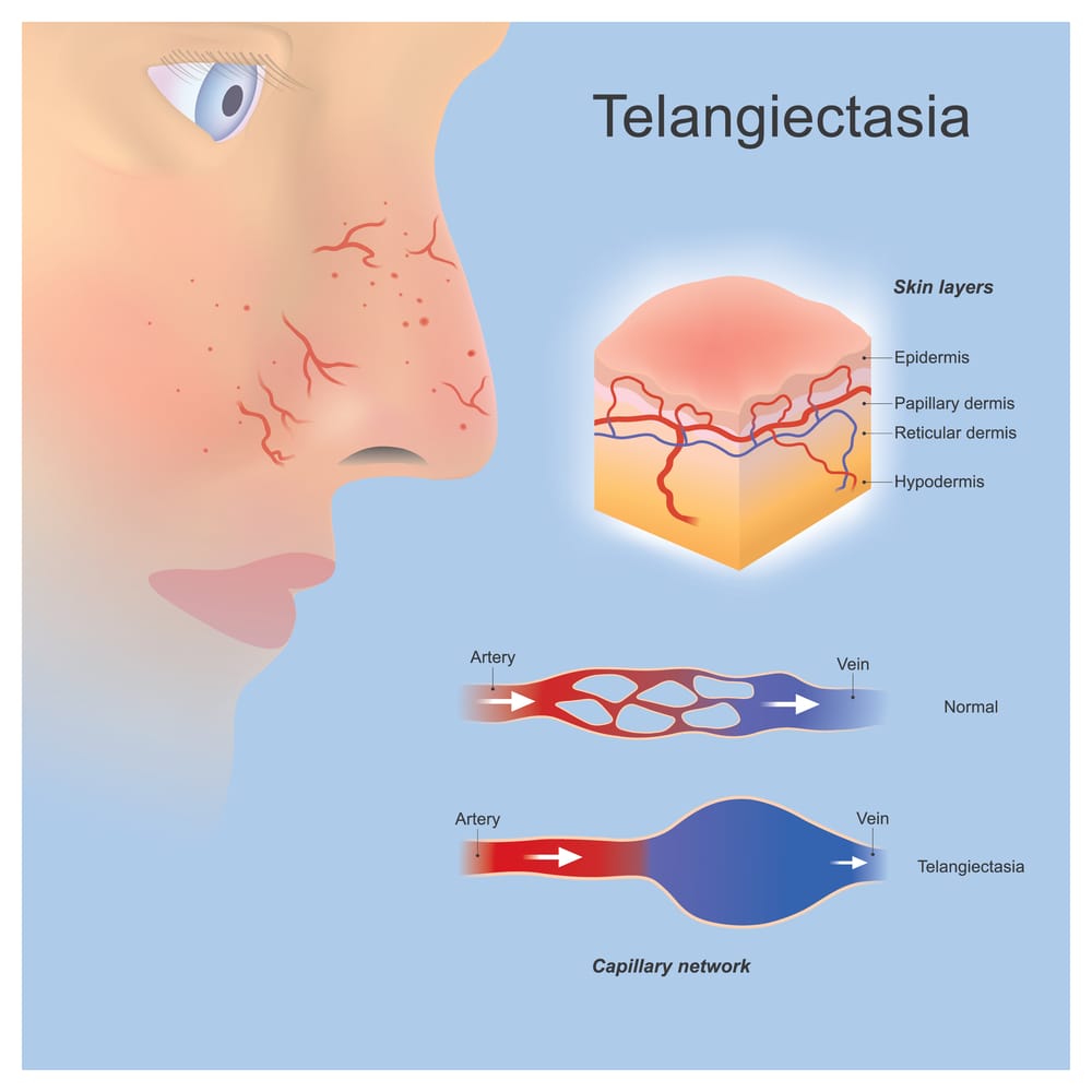 A graphic of a person with Telangiectasia on his nose