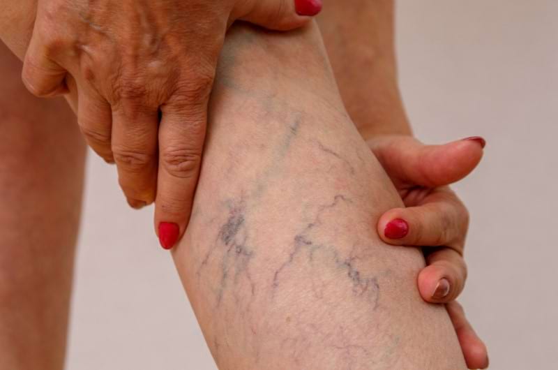 An elderly woman with spider veins on her leg.