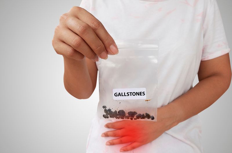 A woman is holding up a small bag of gallstones that she had surgically removed