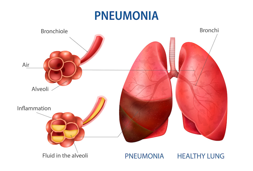 A graphic showing how Pneumonia can affect the lung, and comparing a healthy lung with one where a person has Pneumonia