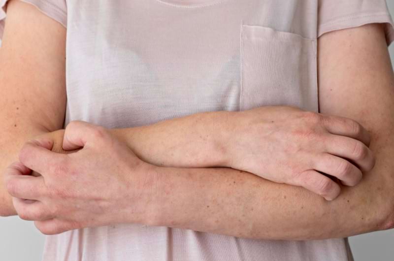 A middle aged woman scratching on her elbows and arms as a sign of lichen sclerosus.