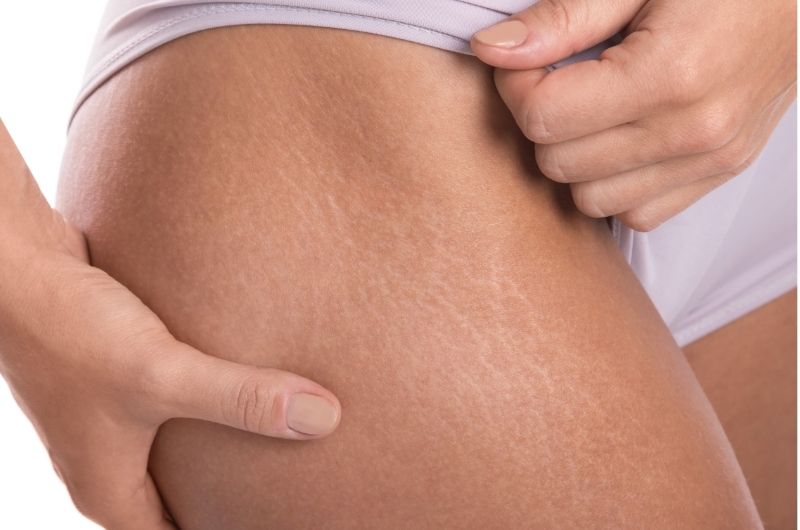 Are Stretch Marks From Weightlifting Considered Unhealthy?