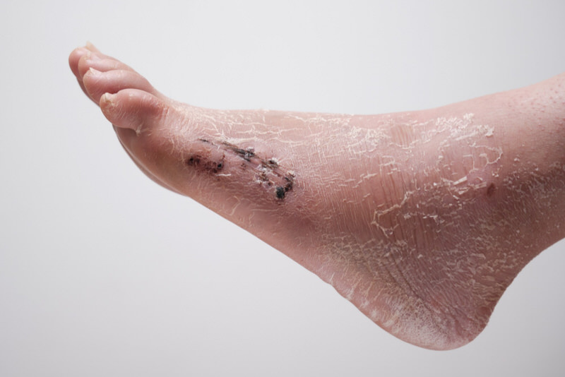 Skin Peeling After Foot Surgery (Desquamation)