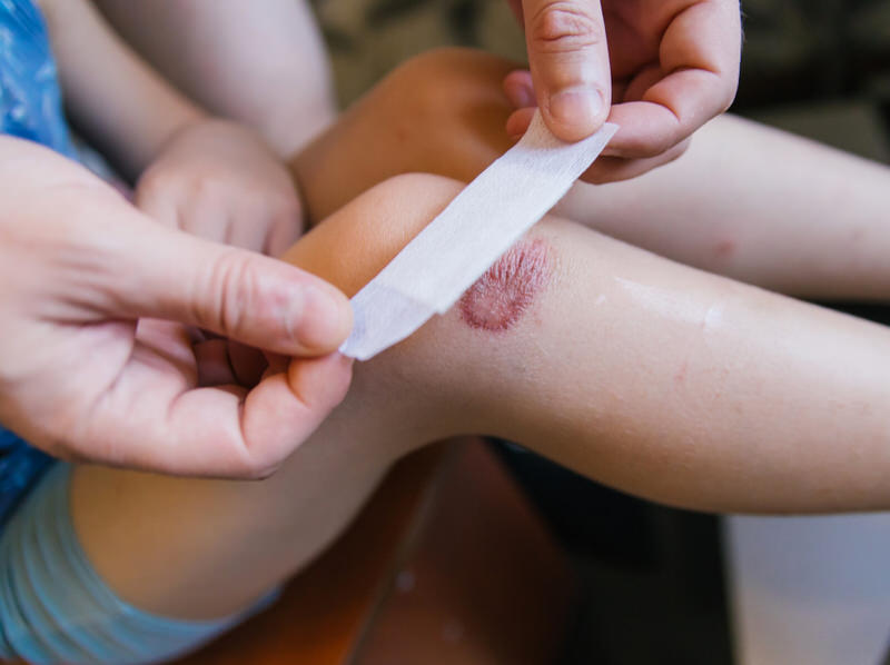 Why Do Band-Aids Leave Scars?