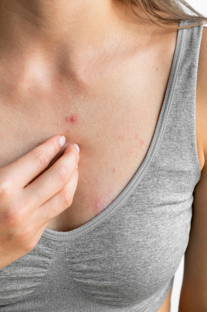 A young woman has a rash on her breast, a possible sign of Intertrigo.