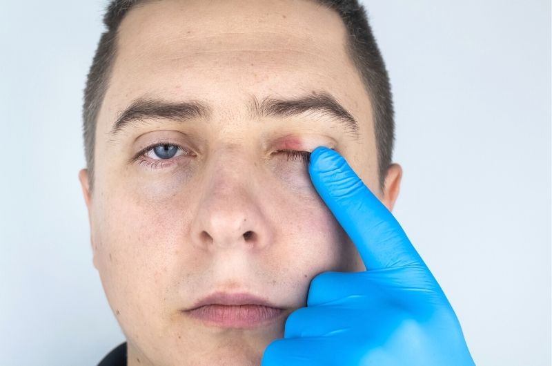 I Cured My Blepharitis (How To Keep Blepharitis Symptoms Under Control)