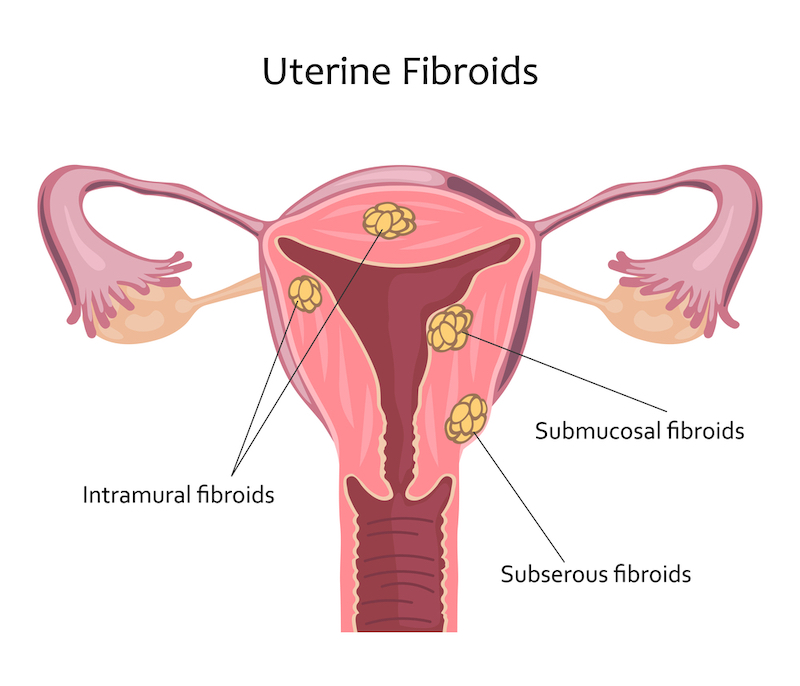 A diagram showing uterine fibroids